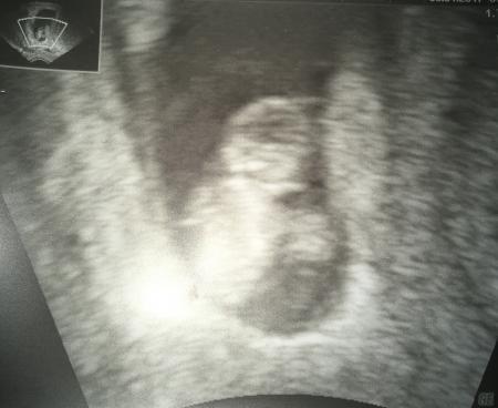 Bild zu Ultraschallbild - Forum für August - Mamis