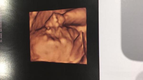 Bild zu 3/4D Ultraschall - Forum für August - Mamis