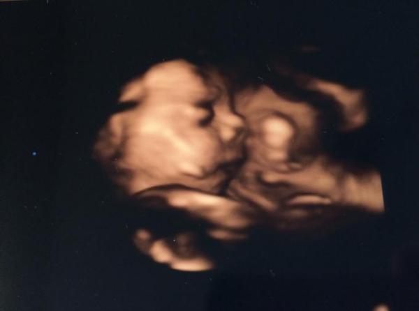 Bild zu 3D Ultraschall gehabt - Forum für August - Mamis