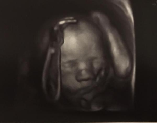 Bild zu Gestern feindiagnostik  - Forum für August - Mamis