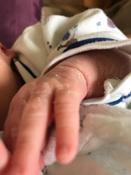 Bild zu Babyhaut pellt sich - Forum für August - Mamis