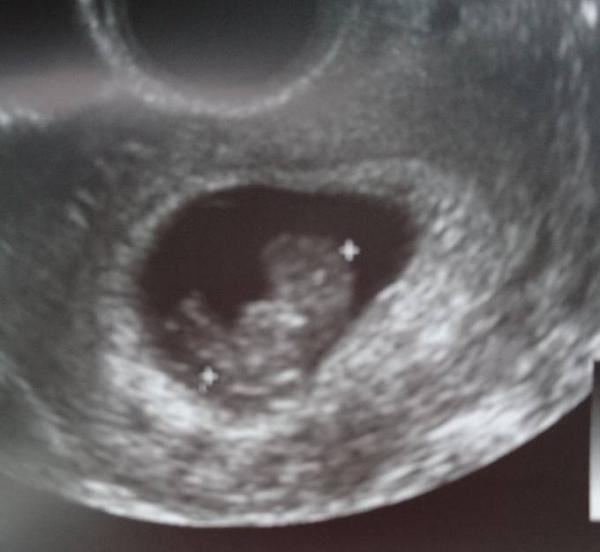 Bild zu Termin geschafft und erleichtert! - Forum für August - Mamis