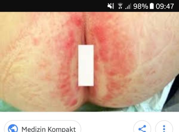 Bild zu Windelpilz? - Forum für August - Mamis