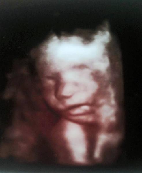 Bild zu 3 Ultraschall - Forum für August - Mamis