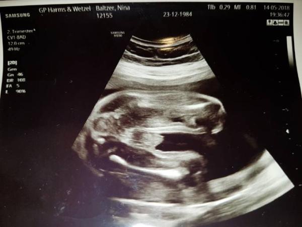 Bild zu Ultraschall Geschlecht - Forum für August - Mamis