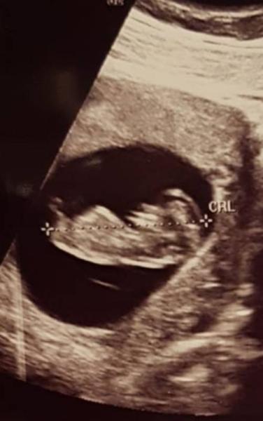 Bild zu Ultraschall - Forum für August - Mamis