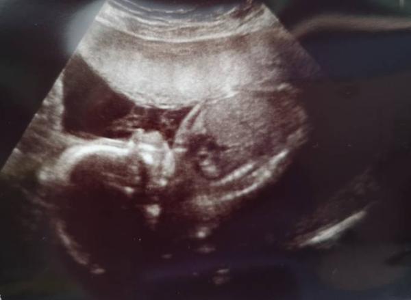 Bild zu Enttäuscht vom 2.Screening - Forum für August - Mamis
