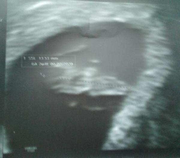 Bild zu Da ist unser Krümel  - Forum für August - Mamis