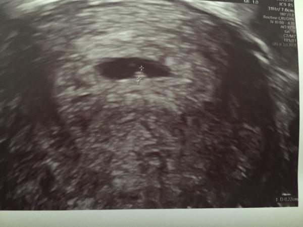Bild zu Herzschlag evtl zu langsam, wie groß sind eure Embryos in 6+0? - Forum für August - Mamis