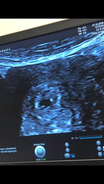 Bild zu Ultraschall frage - Forum für August - Mamis