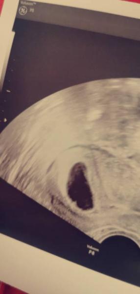 Bild zu kein embryo.. - Forum für August - Mamis