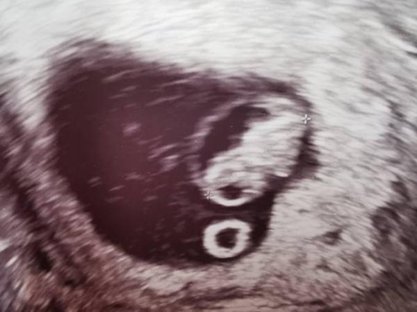 Bild zu Blutungen und Schmerzen - Forum für August - Mamis