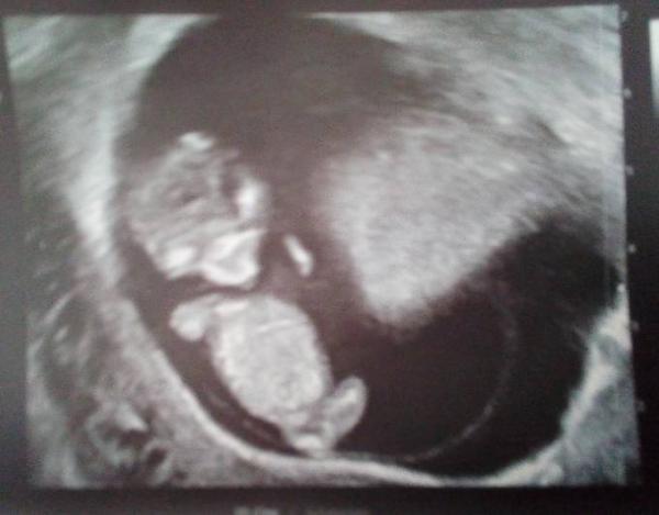 Bild zu Zurück vom zweiten Termin - Forum für August - Mamis