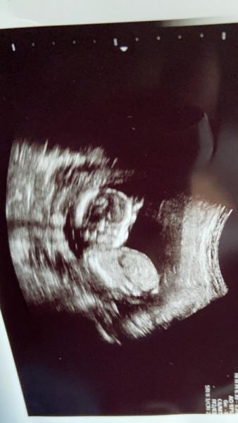 Bild zu Ultraschallbild - Forum für August - Mamis
