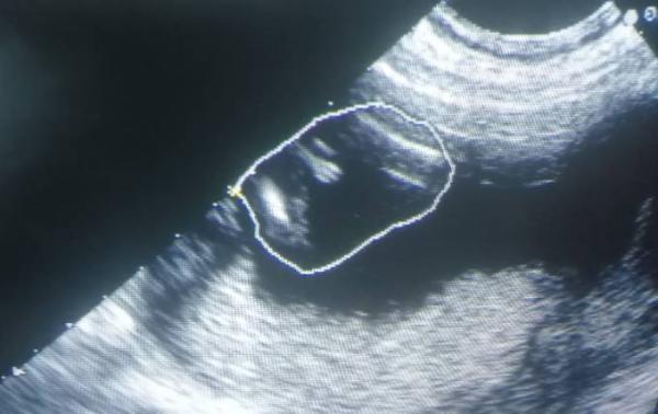 Bild zu Ultraschall geschlecht - Forum für August - Mamis