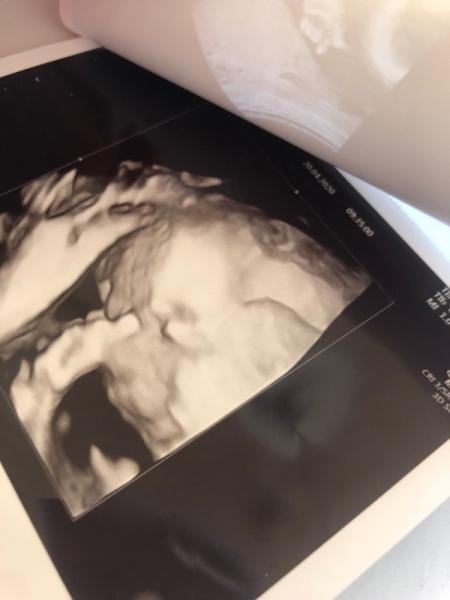 Bild zu Ultraschallbild Frage - Forum für August - Mamis