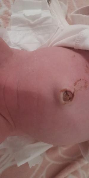 Bild zu Die Nabelschnur am Bauchnabel abgefallen - Forum für August - Mamis
