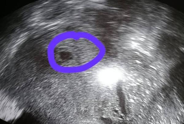 Bild zu Fruchtblase gesichtet - Forum für August - Mamis