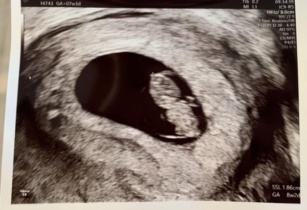 Bild zu Gestern 1. FA Termin, SSW 8 - Forum für August - Mamis