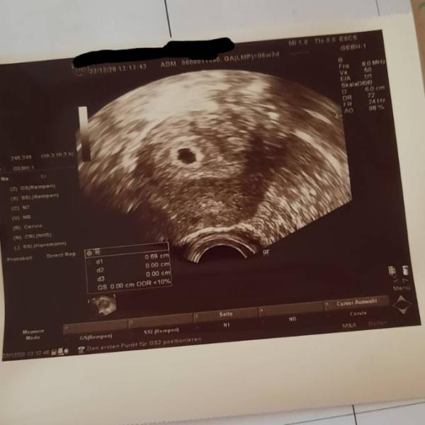 Bild zu Folverlan 5mg, weil kein Embryo? - Forum für August - Mamis