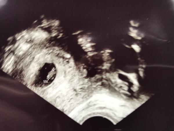Bild zu Heute 1. Ultraschall - Forum für August - Mamis