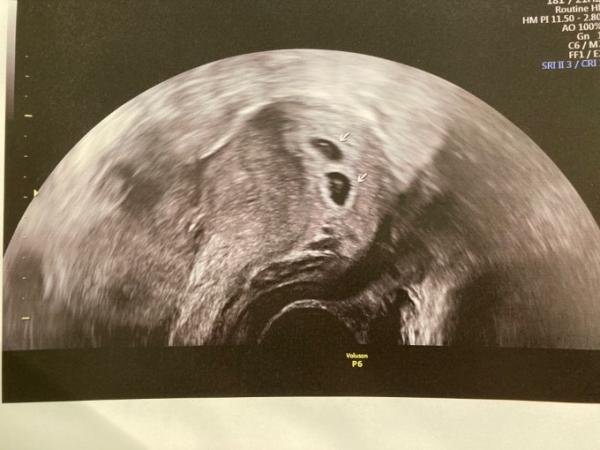 Bild zu 1. Ultraschall mehr als erfolgreich! - Forum für August - Mamis
