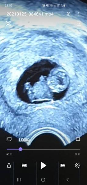 Bild zu Mädchen oder Junge SSW 9+3 - Forum für August - Mamis