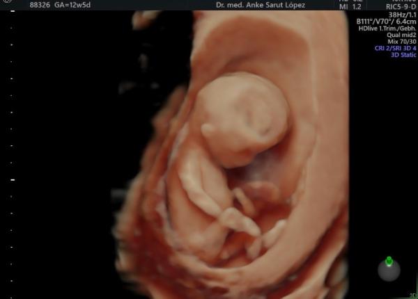 Bild zu Geschlecht auf 3D/4D Ultraschall erkennbar? - Forum für August - Mamis