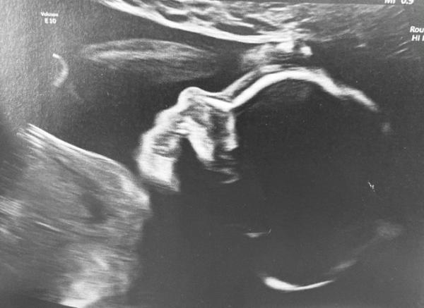 Bild zu Ultraschall đź’™ - Forum fĂĽr August - Mamis