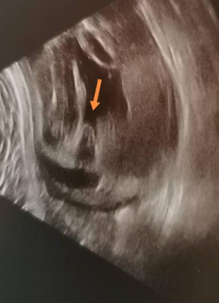 Bild zu 3.US geschafft & Geschlechterraten :) - Forum für August - Mamis