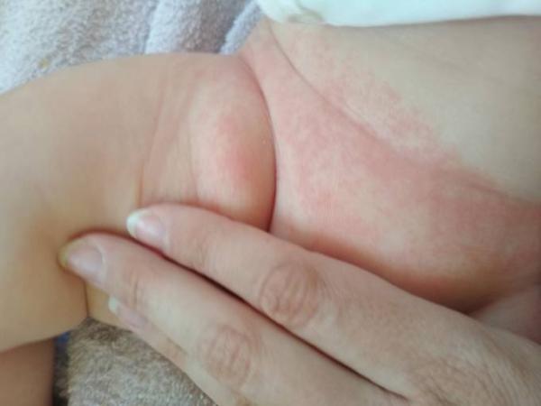 Bild zu Rote Flecken im Intimbereich beim Baby - Forum für August - Mamis