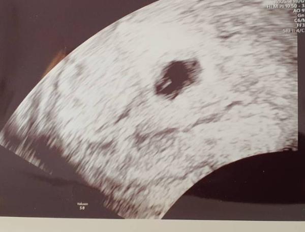 Bild zu 6 ssw . Wie sehen eure ultraschallbilder aus.. - Forum für August - Mamis