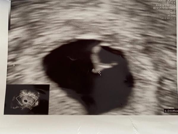 Bild zu Embryo viel zu klein - Forum für August - Mamis