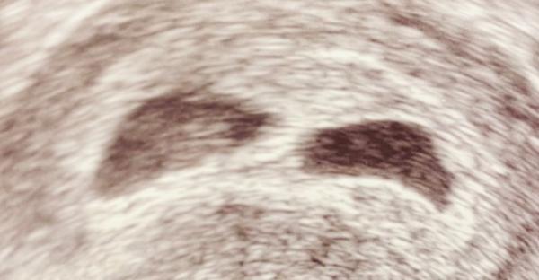 Bild zu Heute erster Ultraschall bei 7+1 - Forum für August - Mamis