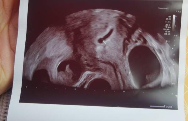 Bild zu Fruchthöhle nicht rund sondern länglich - Forum für August - Mamis