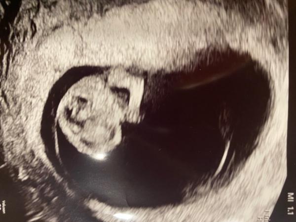Bild zu Heute 2. Ultraschalltermin - Forum für August - Mamis