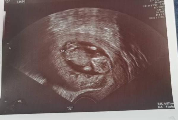 Bild zu Ultraschall Termin - Forum für August - Mamis