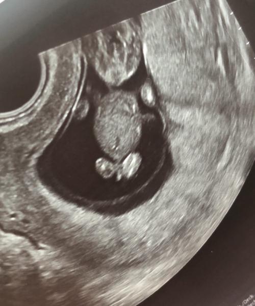 Bild zu Ultraschallbild - Sehr eindeutig! - Forum für August - Mamis