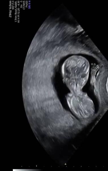 Bild zu Erster großer Ultraschall - Forum für August - Mamis