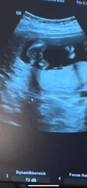 Bild zu Mädchen oder Junge ?19ssw - Forum für August - Mamis