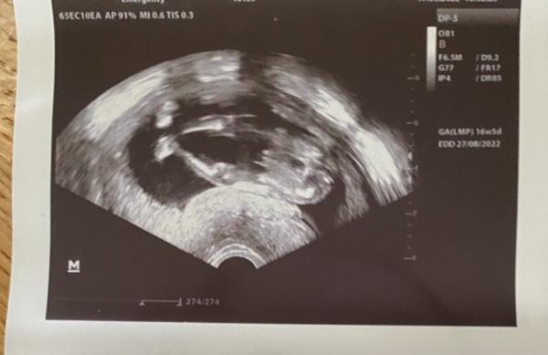 Bild zu Was seht ihr ? 💖 oder 💙 ? - Forum für August - Mamis