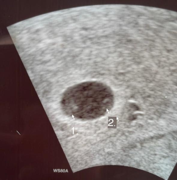 Bild zu Eineiige Zwillinge - Forum für August - Mamis