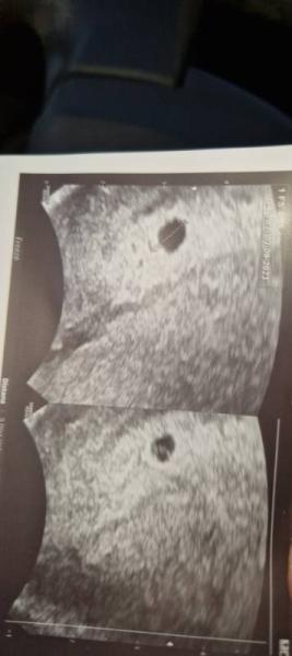 Bild zu Ich bin verwirrt. Eisprung am 5.12. Laut Arzt aber erst 5+3 statt 6+3 - Forum für August - Mamis