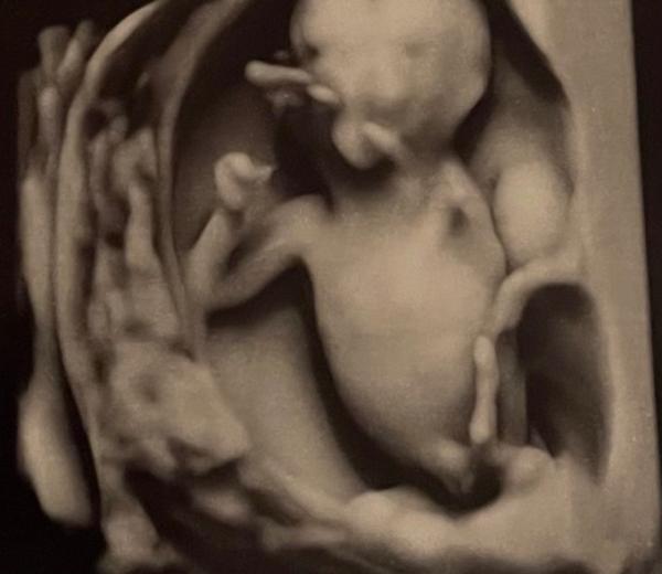 Bild zu Kann man auf diesem Ultraschallbild schon ein Geschlecht erkennen? - Forum für August - Mamis