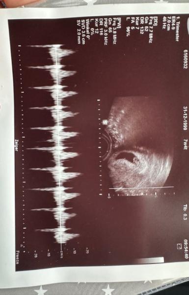 Bild zu 1. Ultraschall Bild - Forum für August - Mamis