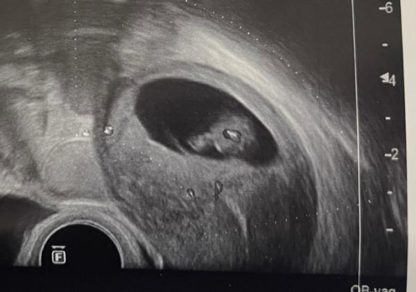 Bild zu Euer Ultraschallbild bei ca. SSW 8+4 - Forum für August - Mamis