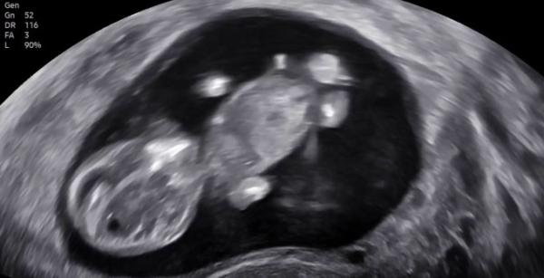 Bild zu Könnt Ihr ein Geschlecht erkennen? - Forum für August - Mamis