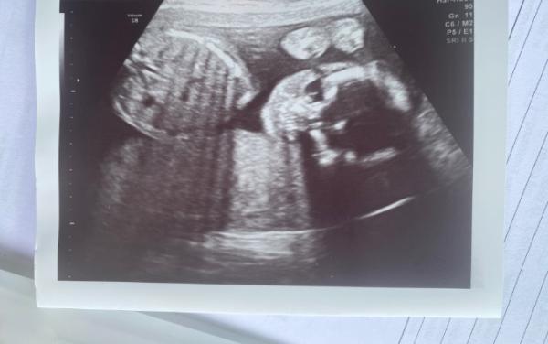 Bild zu 2. großer Ultraschall - Forum für August - Mamis