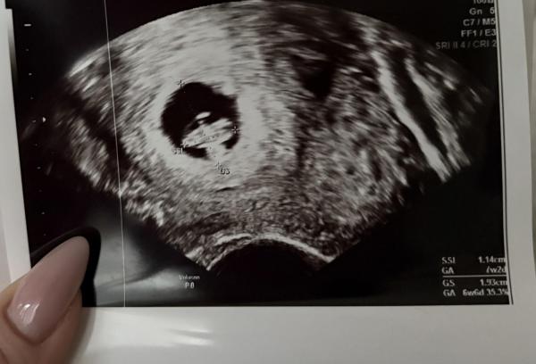 Bild zu Blutungen, mal wieder. :( - Forum für August - Mamis