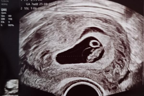 Bild zu Hämatom - Forum für August - Mamis